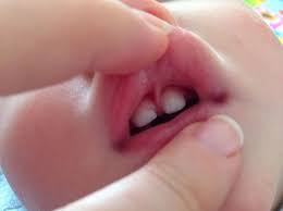 Lip tie with gap between teeth